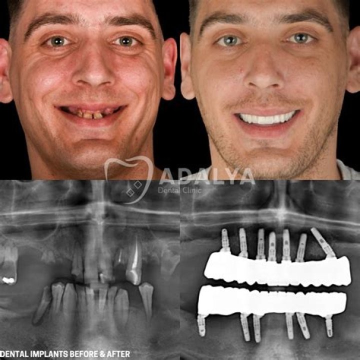 Did She Have Dental Surgery? Before & After