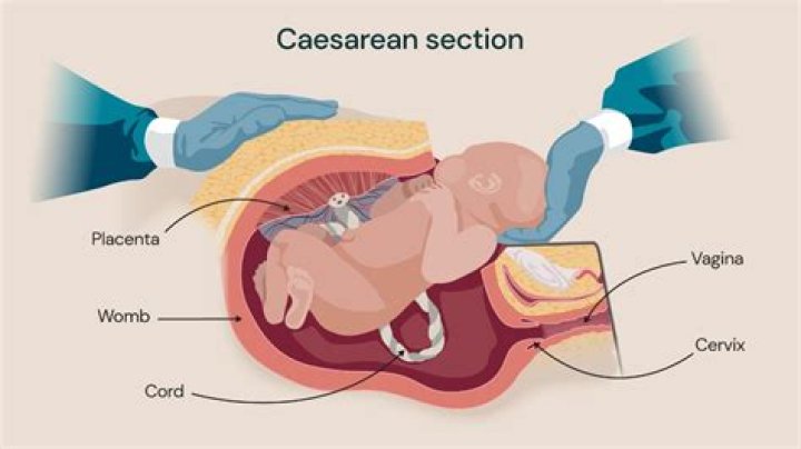 I Want a C-Section—Why Won’t You Give Me One?